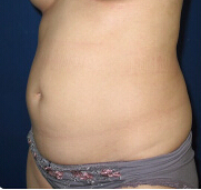 整形前后对比图片