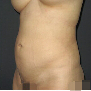 整形前后对比图片