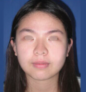 整形前后对比图片