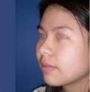 整形前后对比图片