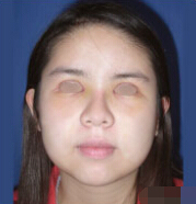 苏秀洁的整形术后图片