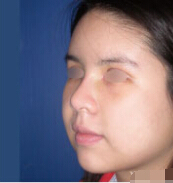 整形前后对比图片