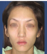 整形前后对比图片