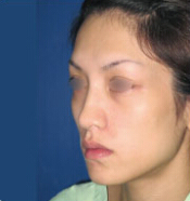 整形前后对比图片