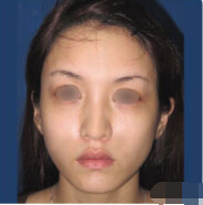 梁桂菊的整形术后图片