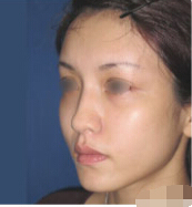 整形前后对比图片