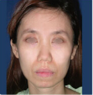 整形前后对比图片