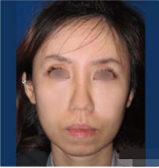 夜如笼的整形术后图片