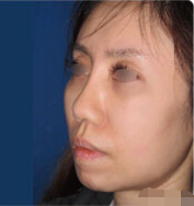 夜如笼的整形术后图片