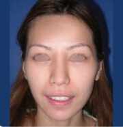 整形前后对比图片