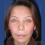宫雅丽的整形术后图片