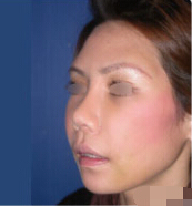 宫雅丽的整形术后图片