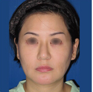 整形前后对比图片