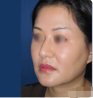 整形前后对比图片