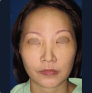 整形前后对比图片