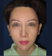 整形前后对比图片