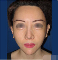 整形前后对比图片