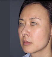 整形前后对比图片