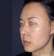 整形前后对比图片