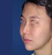 整形前后对比图片