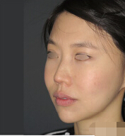 整形前后对比图片