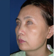 整形前后对比图片