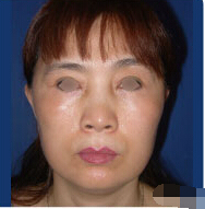 整形前后对比图片