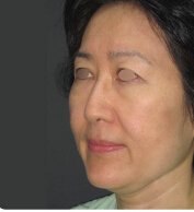 整形前后对比图片