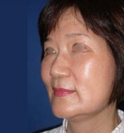 整形前后对比图片