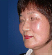 整形前后对比图片