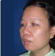 整形前后对比图片