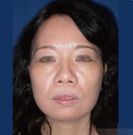 整形前后对比图片