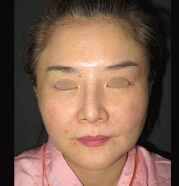 整形前后对比图片