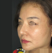 整形前后对比图片