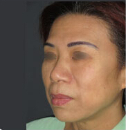 整形前后对比图片