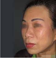 整形前后对比图片