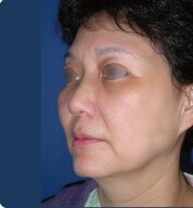 整形前后对比图片