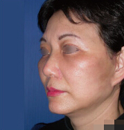 整形前后对比图片