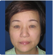 整形前后对比图片