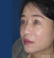 整形前后对比图片