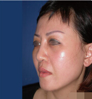 整形前后对比图片