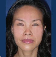 整形前后对比图片