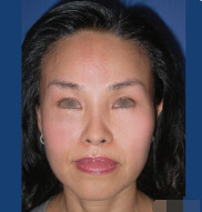 整形前后对比图片