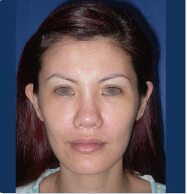 整形前后对比图片