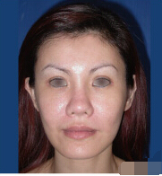 整形前后对比图片