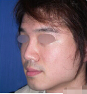 整形前后对比图片