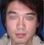 整形前后对比图片