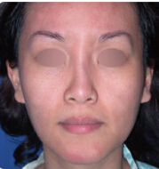 整形前后对比图片