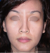 整形前后对比图片