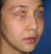 整形前后对比图片